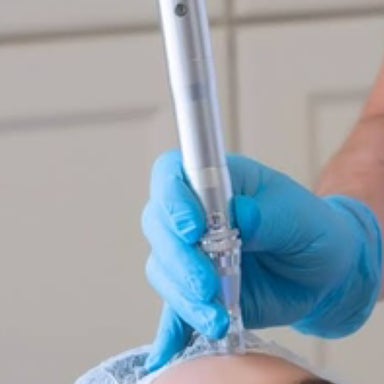 Micro_needling Face & Neck