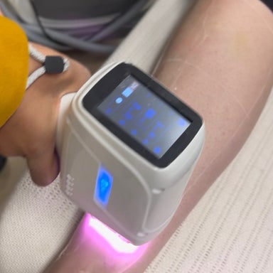 Upperlip/Chin Laser hair removal