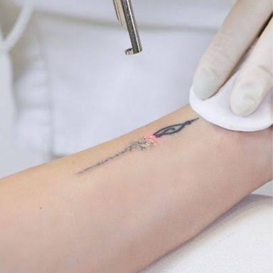 Tattoo Removal