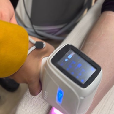 Full Face Laser hair removal